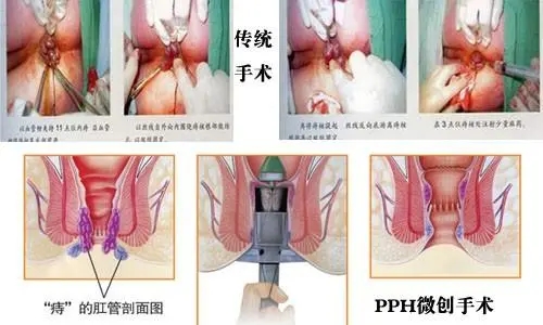 南宁内痔疮的手术费用是多少